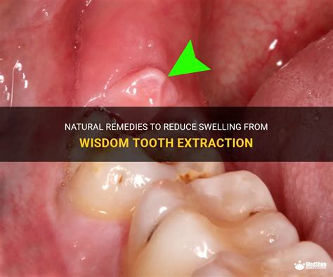 Natural Remedies To Reduce Swelling From Wisdom Tooth Extraction Medshun