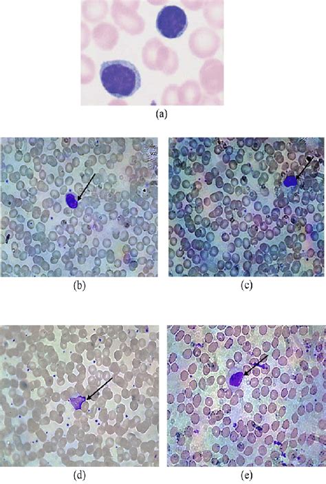 A Lymphocyte Of A Control B Reactive Lymphocyte Of Diagnostic