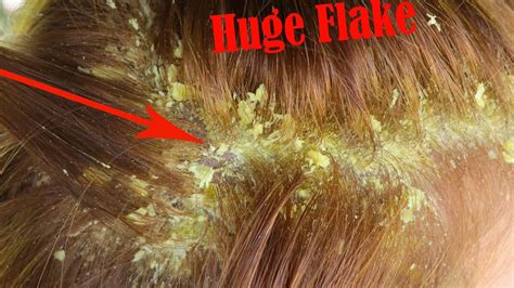 Itchy Dry Scalp Scratching Dandruff Big Flakes On Back Of Head Dandruff Scratching Youtube