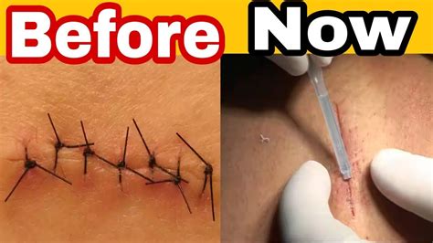 Surgical Glue That Seals Wounds In 60 Seconds By Being Lazy World
