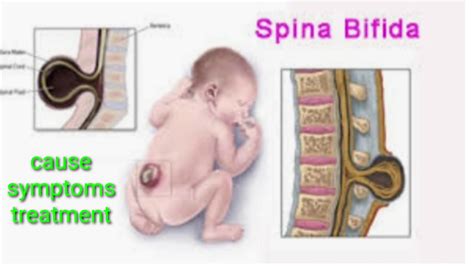 Spina Bifida Cause Symptoms And Treatment In Hindi Youtube