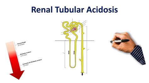 Renal Tubular Acidosis Made Simple YouTube