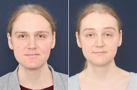Charlotte Before And After Ffs 2pass Clinic