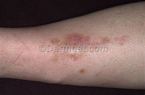 Diabetic Dermopathy Overview And Pictures