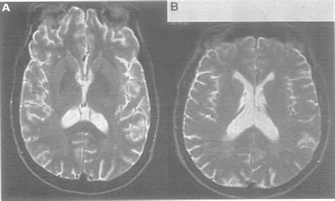 T2 Weighted Mri Showing Patchy Diffuse White Matter Hyperintensity In A