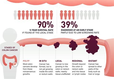 Because the large majority of colon cancers occur in people older than 50, however, the disease may go undetected in those who are younger until the cancer is more advanced. New Blood Test for Colon Cancer Improves Colonoscopy ...