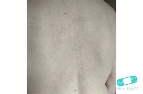 White Spots On Skin Pictures Causes Treatment