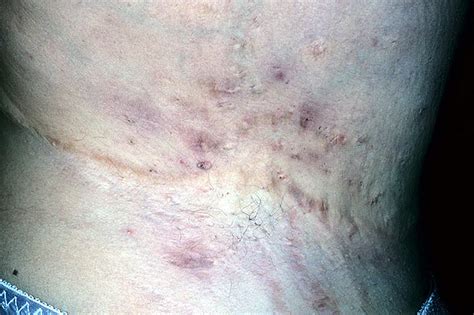 Axillary Hidradenitis Pictures 54 Photos And Images