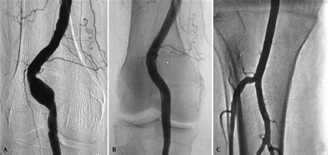 Endovascular Treatment Of Popliteal Artery Aneurysms