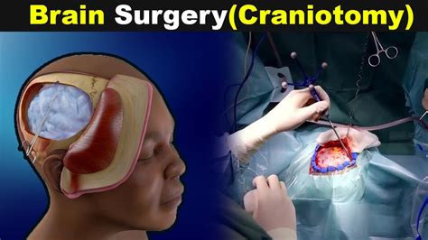 How Does Human Brain Surgery Works Craniotomy Explained Urduhindi