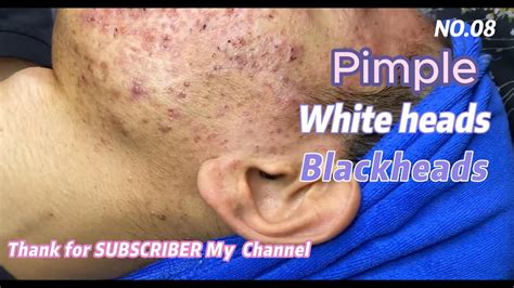 How To Remove Blackheads And White Heads On Facial At Home Nasa809 Youtube