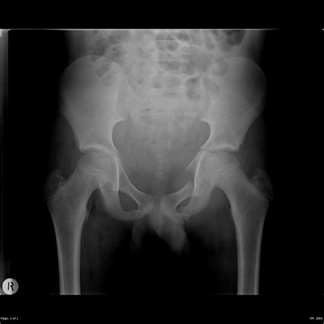 Lateral Compression Pelvic Injury Image