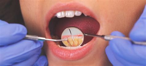 Periodontitis Causes Symptoms And 5 Natural Remedies Dr Axe