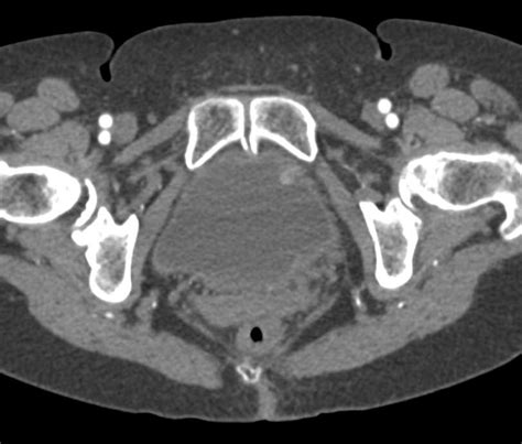 Multifocal Transitional Cell Carcinoma In Left Renal Pelvis And Bladder