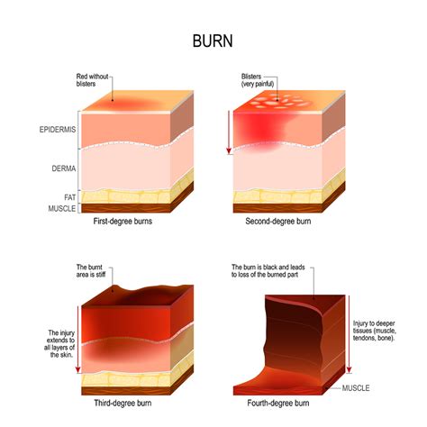 The Impact Of Hyperglycemia In Burn Trauma Monarch Medical Technologies