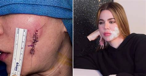 khloé kardashian reveals huge facial scar after skin cancer scare
