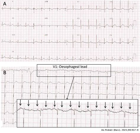 Complete Atrioventricular Block Associated With Respiratory Syncytial