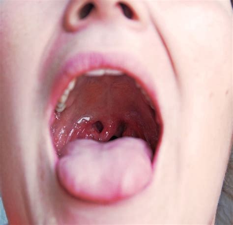 Throat cancer causes, signs and symptoms. does it look like strep? | Flickr - Photo Sharing!