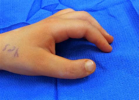 Triphalangeal Thumb Congenital Hand And Arm Differences Washington