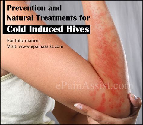 Prevention And Natural Treatments For Cold Induced Hives Or Cold Urticaria