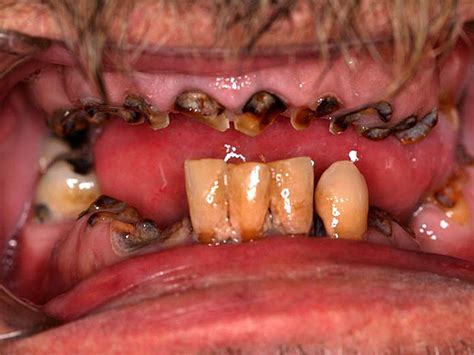 Meth Mouth Inside Look At Icky Problem 15 GRAPHIC IMAGES Photo 1