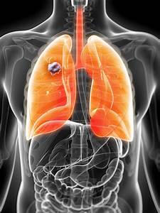 Lung Cancer - Net Health Book Lung Cancer  