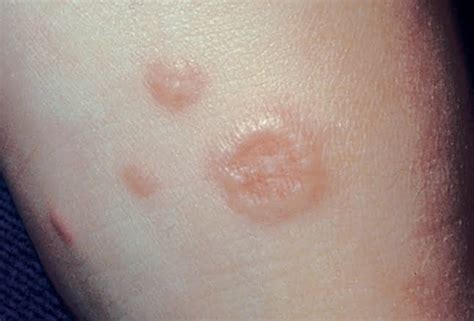 Get All The Information About Granuloma Annulare Symptoms And Causes