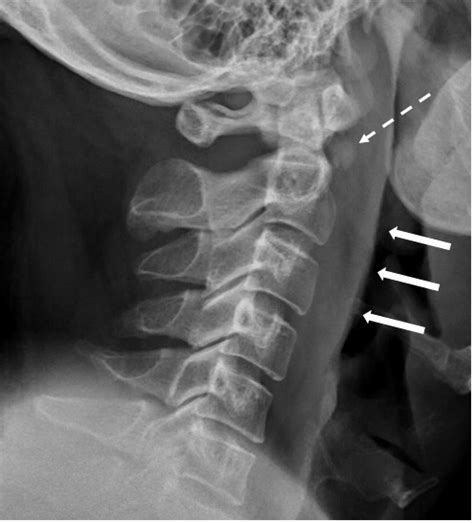 Neck Pain With Prevertebral Soft Tissue Thickening Annals Singapore