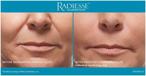 Experience Radiesse Filler In The Hands Of Expert Injector Dominique