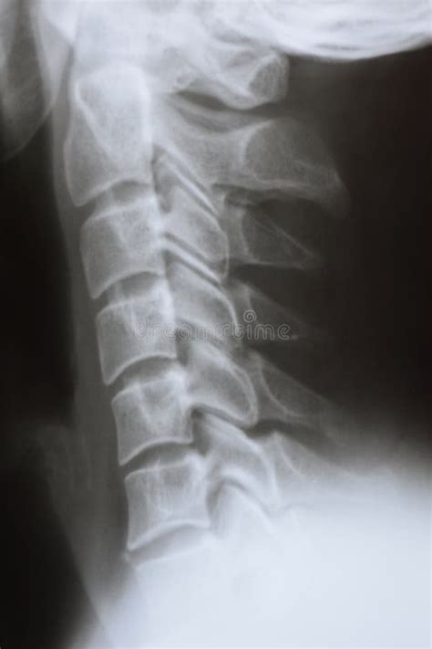 Lateral X Ray Of The Neck And Cervical Spine Of A Person Stock Photo