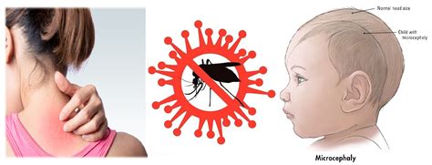 Zika Virus Infection Causes Sign And Symptoms Mode Of Transmission
