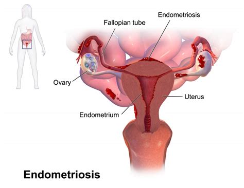 Qu Es La Endometriosis Y Por Qu Hay Fallas En Su Diagn Stico