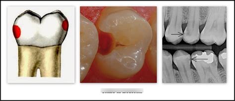 Gv Blacks Classification Of Dental Caries And Restorations Diagram