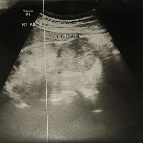 Ultrasonography Of Abdomen Showing A Well Defined Hypoechoic Mass