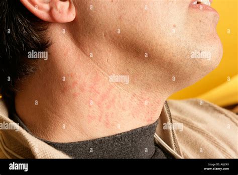 Rash Neck Hi Res Stock Photography And Images Alamy