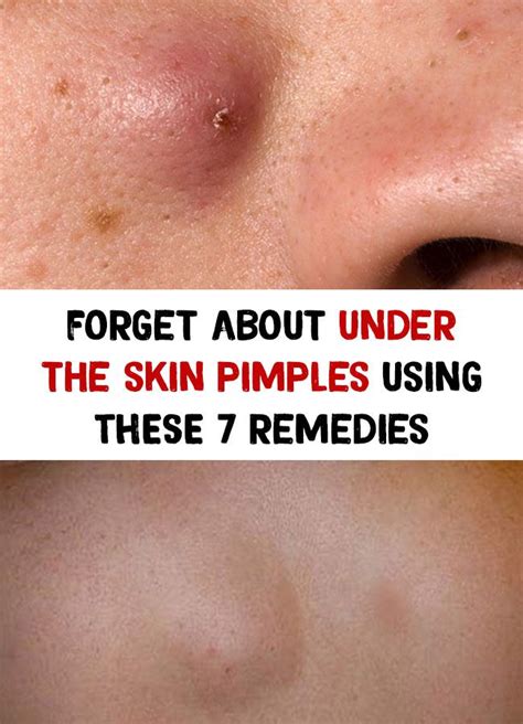Forget About Under The Skin Pimples Using These 7 Remedies Pimples