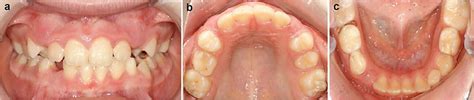 A C Clinical Intraoral Examination Frontal View In Occlusion