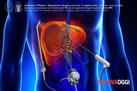 Tumore Al Fegato Operato In Laparoscopia Si Rigenera Al 100