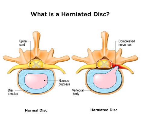8 Tips To Avoid A Herniated Disc Minimizing The Risks Spine And Pain
