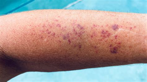 Idiopathic Thrombocytopenic Purpura Rash