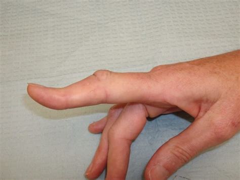 The 5 Most Common Finger Injuries In Brazilian Jiu Jitsu And Judo