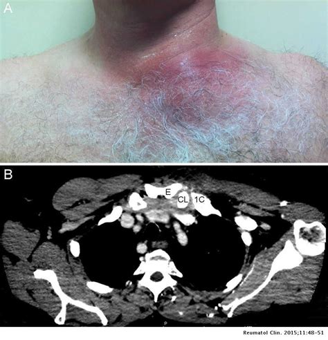Sternoclavicular Septic Arthritis A Series Of 5 Cases And Review Of