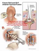 Cervical Discectomy Recovery
