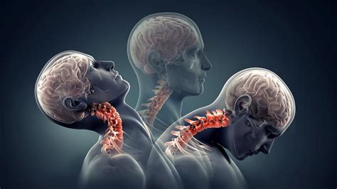 Cervical Fracture Injury Neck Injury Choices