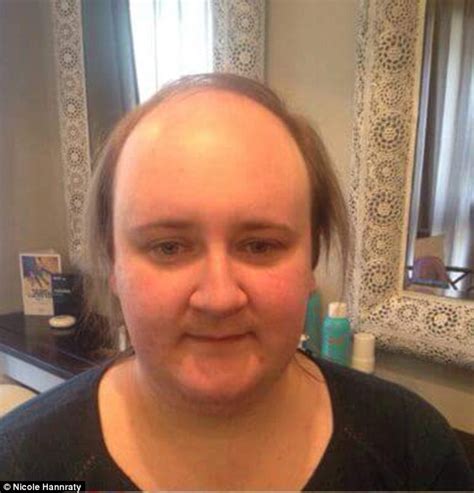 woman who went bald at just 20 says gluing £250 hairpieces to her scalp have helped restore her