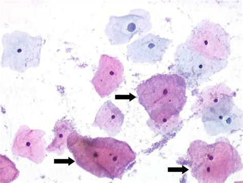 Pathology Outlines Bacterial Vaginosis