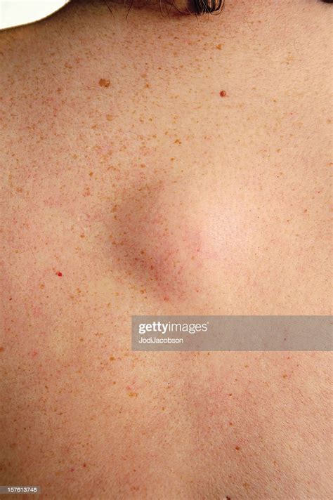 Lipoma Tumor High Res Stock Photo Getty Images