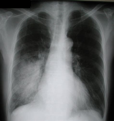 Pneumonia Causes Symptoms Treatment Pneumonia