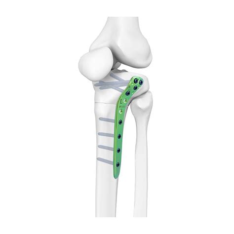Proximal Lateral Tibial Osteotomy Lcpmedical Device Manufacturers