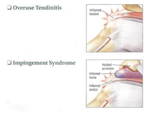 Shoulder bursitis is often accompanied by tendinitis of tendons adjacent to the affected bursa in the shoulder. Shoulder Calcific Tendinitis | Dr Skedros Orthopaedics